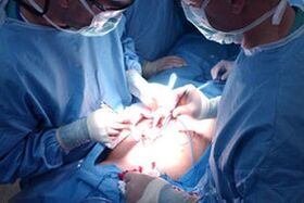 Performing a penis enlargement surgery